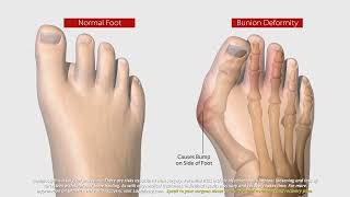 What Is Lapiplasty® 3D Bunion Correction®  All About The Lapiplasty® Procedure [upl. by Anelah13]