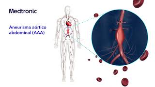 ¿Qué es el aneurisma aórtico abdominal AAA [upl. by Michelle]