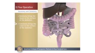 ColostomyIleostomy Your Operation [upl. by Ahsahs]