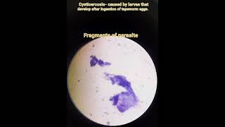 Cysticercosis Taenia solium parasitic infectionPathologyFNACCytology smear [upl. by Cuhp]