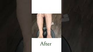 Lipedema Surgery  Before amp After  Dr Boris Volshteyn [upl. by Emixam392]