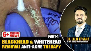 BLACKHEAD amp WHITEHEAD REMOVAL ANTIACNE THERAPY PART  1 [upl. by Leifeste]