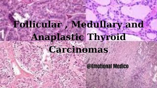 Follicular  Medullary and Anaplastic Thyroid Carcinomas  emotionalmedico [upl. by Severson245]