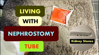 Nephrostomy Tube  Nefrostomi  Nephrostomy Journey  Nephrostomy Tube Care  Nephrostomy Tips [upl. by Tuck]