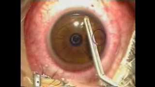 Lasik Laser Eye Surgery Procedure  Live Surgery [upl. by Ahsataj]