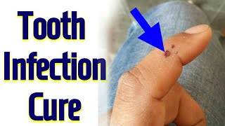 Single Acupressure Point For Infection In Teeth  Tooth DECAY  Tooth pain  Tooth Infection  Hindi [upl. by Ahsratal960]