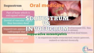 Sequestrum Vs Involucrum  Osteomyelitis  Oral Medicine  Dentophile [upl. by Collie]