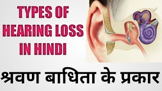 Types Of Hearing Loss In Hindi  Conductive Hearing Loss  Behrapan Ke Prakar [upl. by Llekim495]