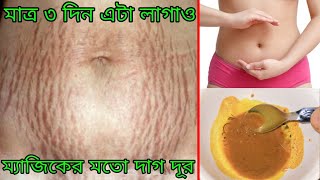 মাত্র ৩ দিন এটা লাগাও ম্যাজিকের মতো গর্ভকালীন ফাটা দাগ ও স্ট্রেচ মার্ক গোড়া থেকে দূর হবে [upl. by Selmner]