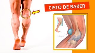 Cisto de Baker Exercício Alívio Dor Atrás do Joelho  Clínica de Fisioterapia Dr Robson Sitta [upl. by Akenihs]