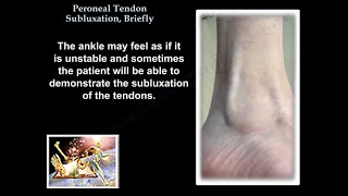 Peroneal Tendon Subluxation Briefly  Everything You Need To Know  Dr Nabil Ebraheim [upl. by Nedla]