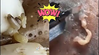 Ultimate Pimple Popping Compilation  Extreme Acne Treatment  Satisfying Blackhead Removal [upl. by Odelet726]