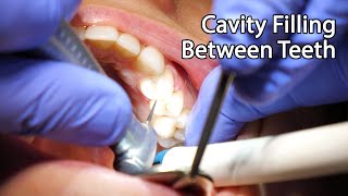 Dentist Filling A Cavity Between Teeth [upl. by Neerol]