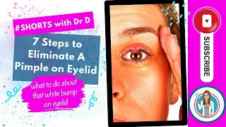 7 Steps to eliminate that bump on eyelid  Pimple on Eye What to do about it shortsyoutube [upl. by Piegari145]