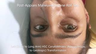 Transformation of Apogeotropic Horizontal Canal BPPV to Geotropic Variant [upl. by Oilegor]