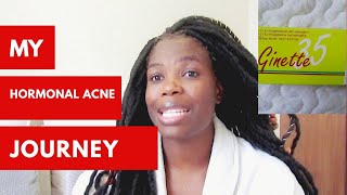 Birth control that clears ance  hormonal acne  South African Youtuber [upl. by Laughry]