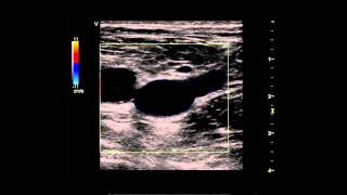 Limited Examination of The Lower Extremity Venous System for DVT [upl. by Ambrosio]