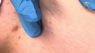 Ingrown Hair Extraction  Skin  Episode 47 [upl. by Slifka]