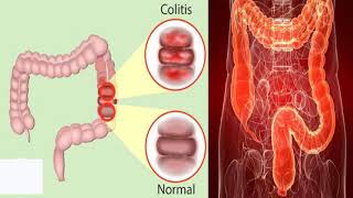 कोलाइटिस बीमारी के है ये लक्षण और संकेत जिसके जरिये आप इसे पहचान सकते हैkolaitis ke lakshan [upl. by Notgnillew302]