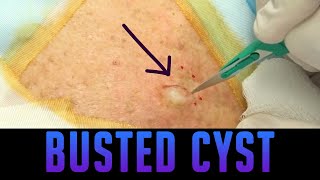 Excellent Epidermoid Cyst Excision [upl. by Dearr150]