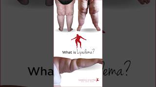 What is Lipedema Take a look here lipedema lipoedema shortsfeed [upl. by Bergin]