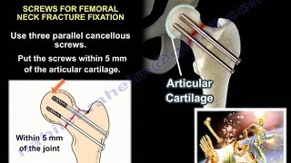 Hip Fractures  Everything You Need To Know  Dr Nabil Ebraheim [upl. by Ahsikal]