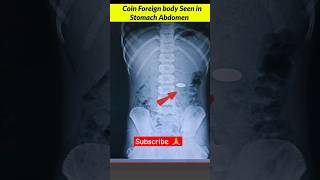 Coin 🪙 in Stomach Abdomen Xray xray radiology radiographerusn [upl. by Chobot]