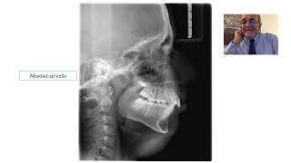 Landmarks on Lateral Cephalogram [upl. by Jerald]