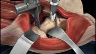 Direct Anterior Approach Hip Replacement [upl. by Myca552]