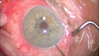 Removal of Durysta Implant from Eye [upl. by Flessel178]