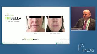 IMCAS Presentation with Dr Neil Sadick on TriBella™ [upl. by Cleveland686]