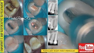 one visit endodontic treament one curve micromega rewalling grandioso endoseal MTA maruchi [upl. by Eneluj110]