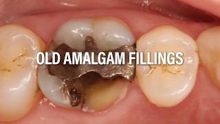 Replace your old amalgams with porcelain restorations with Dr Samadian [upl. by Aleihs]