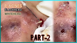 Big Cystic Acne Blackheads Extraction Blackheads amp Milia Whiteheads Removal Pimple Popping [upl. by Aneehsram]