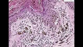 Histopathology SkinLentiginous junctional nevus hypermela [upl. by Ahsircal]