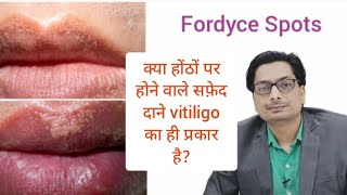 Fordyce Spots  क्या होंठों पर होने वाले सफ़ेद दाने vitiligo का ही प्रकार है vitiligo Leucoderma [upl. by Llerruj801]