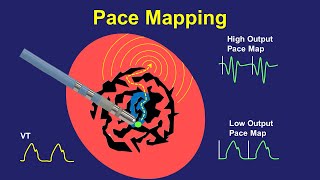 Pace Mapping Principles and Pitfalls [upl. by Kreitman108]