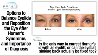 Cause of Horners Syndrome Must be Determined before Corrective Eye and Eyelid Surgery [upl. by Aidyn884]