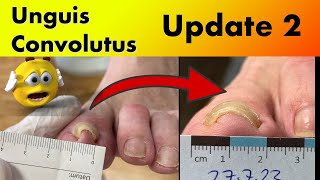 Update 2 Unguis convolutus podologinandrea [upl. by Haleeuqa]