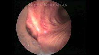 Bronchoscopy for Lung Cancer [upl. by Names532]