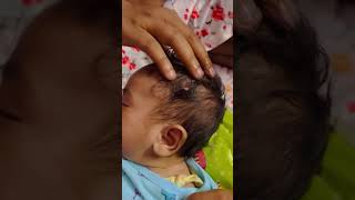 Home care for removing cradle cap in babiescradle cap removal [upl. by Bruckner]