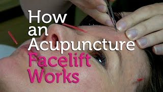 How an Acupuncture Facelift Works [upl. by Nahtan179]