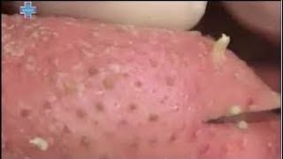 Removing Acne Easily  Acne Treatment [upl. by Ahsiad]