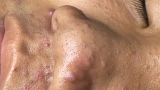 ACNE TREATMENT VU QUYNH MI  Blackheads Chin amp Nose Of Tweens 2024 [upl. by Lacee188]