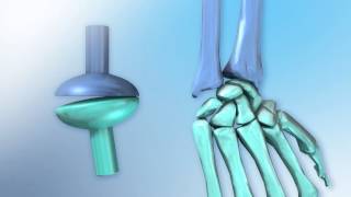 Condyloid Joint [upl. by Nessi4]