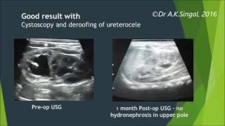 Cystoscopy amp deroofing treatment for ureterocele in a child Dr AKSingal Mumbai India [upl. by Finegan771]