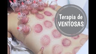 TERAPIA DE VENTOSAS  MINHA EXPERIÊNCIA [upl. by Yaned]