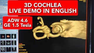 3D Cochlea on ADW 46  Live Demo in English [upl. by Eri314]