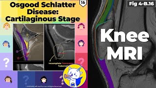 Fig 4B16 Osgood Schlatter Disease Cartilaginous Stage [upl. by Hermann227]