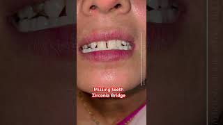 The Key to a Confident Smile Transforming Missing Teeth with Zirconia Bridge [upl. by Adnyleb317]